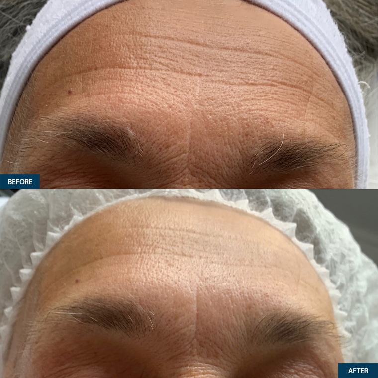 Microneedling